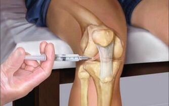 injection intra-articulaire dans l'articulation pour arthrose