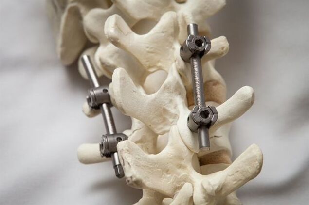 fixation de la colonne vertébrale ostéochondrose du cou