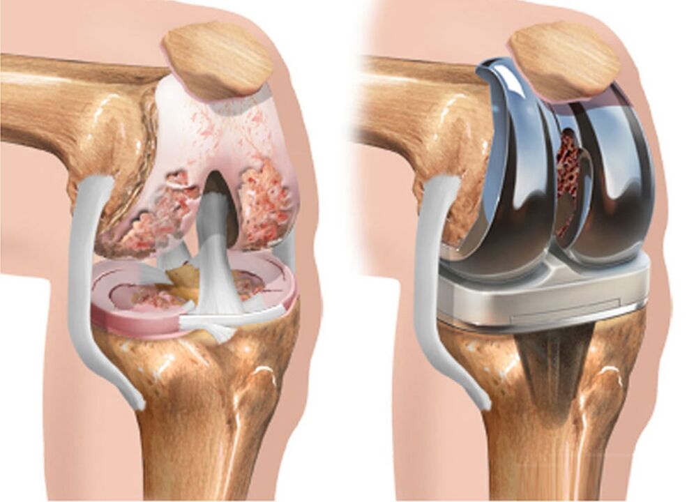 avant et après arthrose de l'articulation du genou pour arthrose