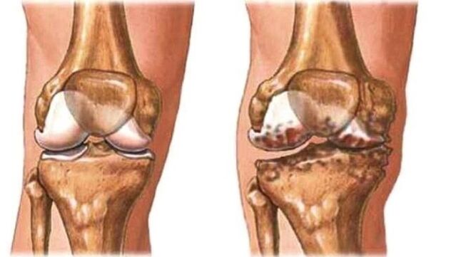 genou sain et arthrose du genou