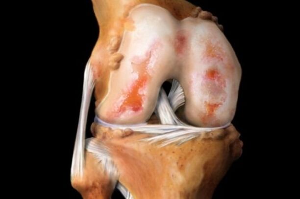 lésions du cartilage dans l'arthrose du genou