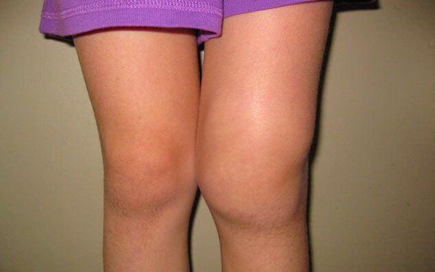 articulation du genou enflée due à l'arthrose