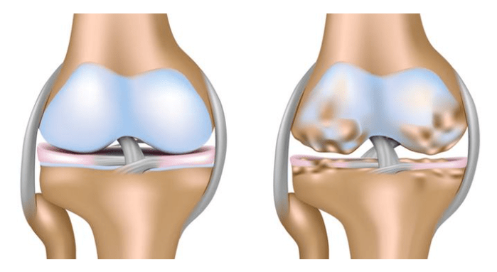 cartilage sain et lésions de l'articulation du genou avec arthrose