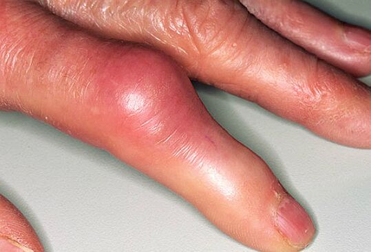 La goutte s'accompagne de douleurs aiguës dans les doigts et d'un gonflement des articulations. 