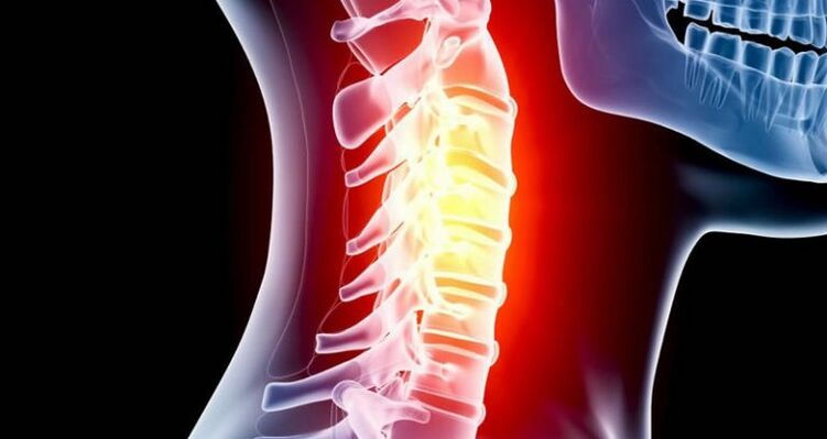 Inflammation de la région cervicale