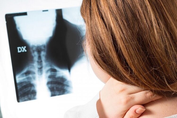 X-Ray de la région cervicale