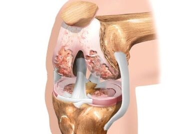 Dommage à l'arthrose articulaire du genou